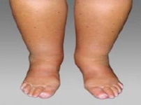 Ayak Bileği Kemik Ödemi Belirtileri ve Tedavisi Ayak Bileği Kemik Ödemi Belirtileri ve Tedavisi