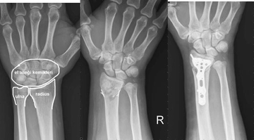 Bilek Kırığı Belirtileri ve Tedavisi Bilek Kırığı Belirtileri ve Tedavisi