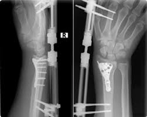 Kırık Bilek Belirtileri ve Tedavisi Kırık Bilek Belirtileri ve Tedavisi