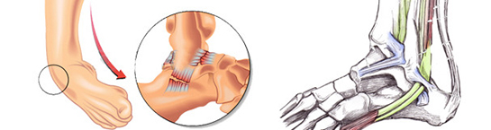 Ayak Bileği Kireçlenmesi Belirtileri ve Tedavisi